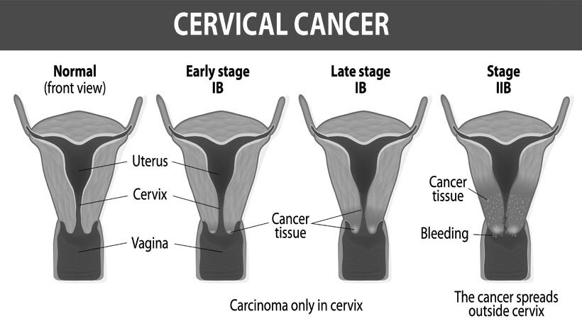HEALTH: Women should not die of cervical cancer | Edge Davao