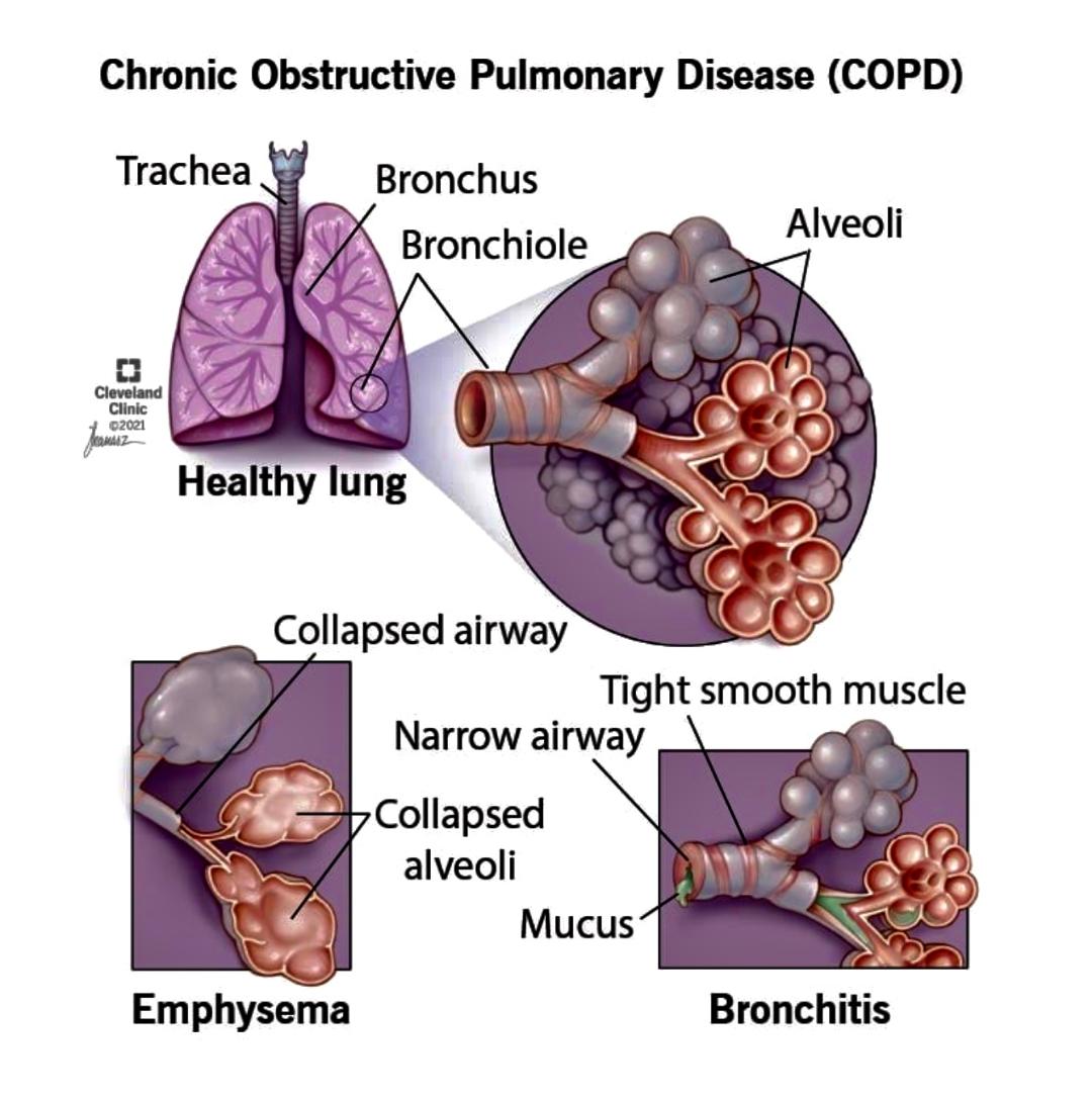 HEALTH: A slow-motion death called chronic obstructive pulmonary ...